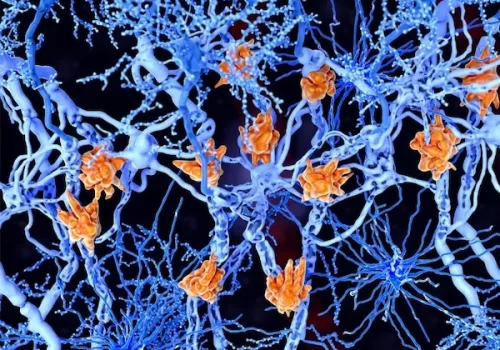 Medicina-regenerativa-poniendo-freno-a-la-esclerosis-multiple Medicina-regenerativa-poniendo-freno-a-la-esclerosis-multiple